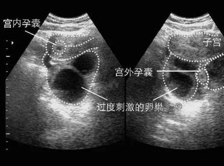 宁夏做三代试管婴儿成功率和费用公开，让你心中有数！